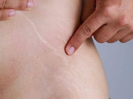 Hướng dẫn cải thiện rạn da tuổi dậy thì an toàn, hiệu quả tại nhà